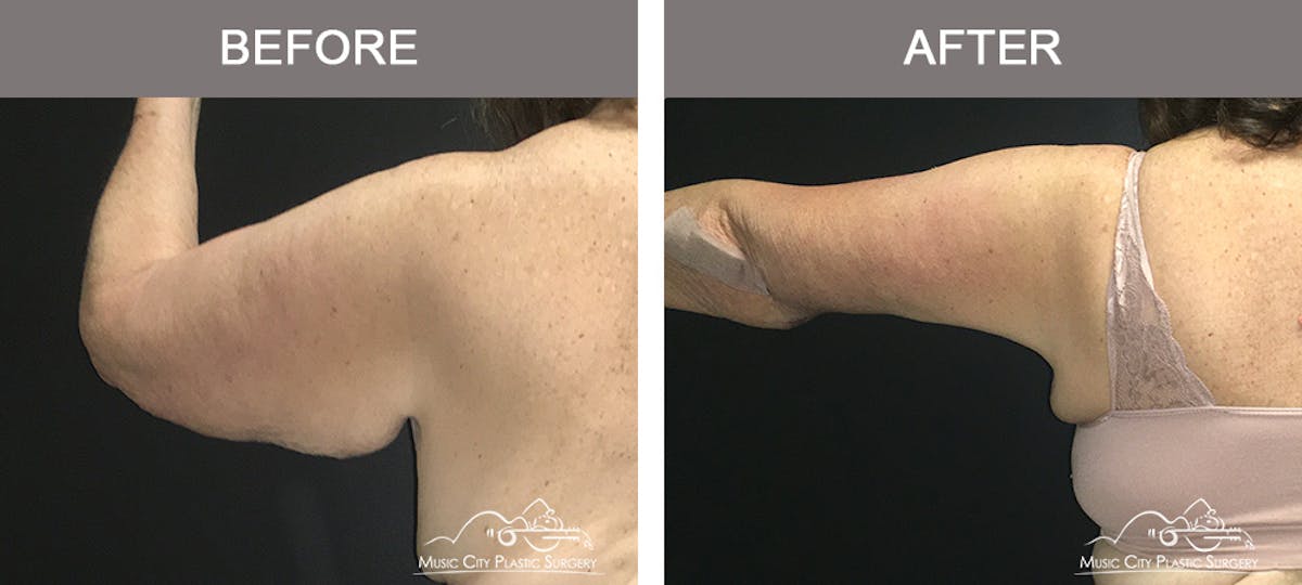 Arm Lift Before & After Gallery - Patient 391156 - Image 1