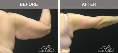 Arm Lift Before & After Gallery - Patient 391156 - Image 2