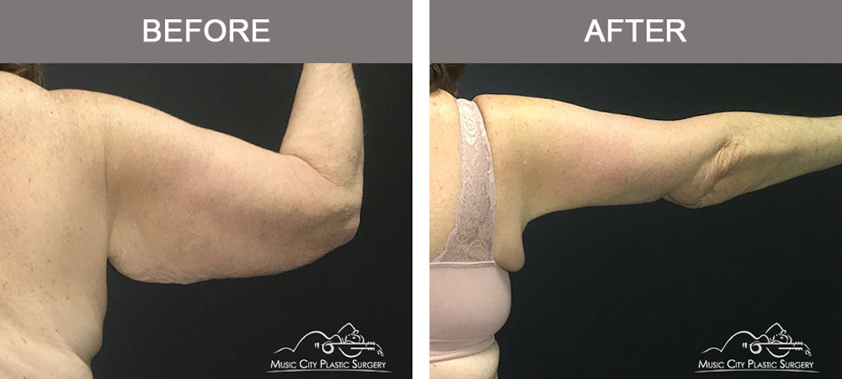 Arm Lift Before & After Gallery - Patient 391156 - Image 2