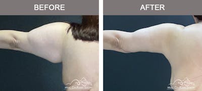 Arm Lift Before & After Gallery - Patient 271306 - Image 1