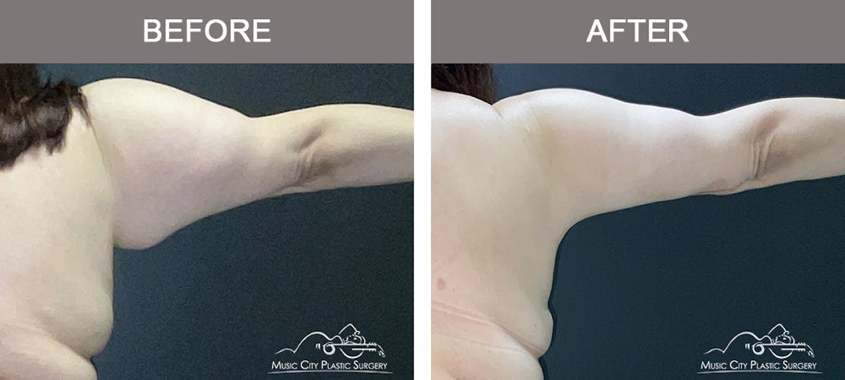 Arm Lift Before & After Gallery - Patient 271306 - Image 2