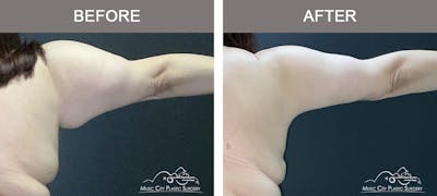 Arm Lift Before & After Gallery - Patient 271306 - Image 2