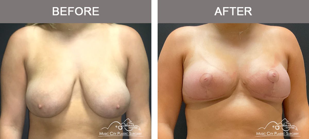 Breast Lift Before & After Gallery - Patient 336282 - Image 1