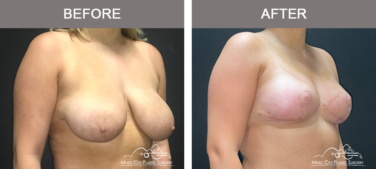 Breast Lift Before & After Gallery - Patient 336282 - Image 2