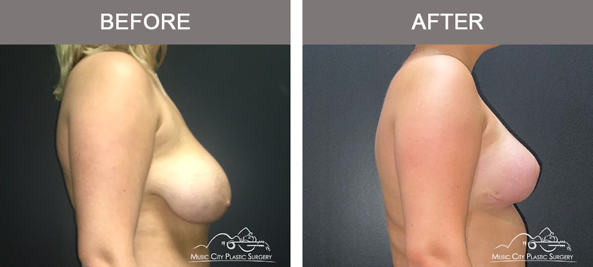 Breast Lift Before & After Gallery - Patient 336282 - Image 3