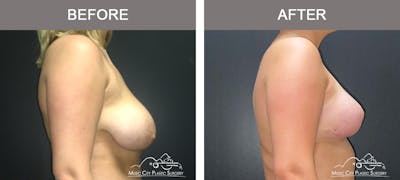 Breast Lift Before & After Gallery - Patient 336282 - Image 3