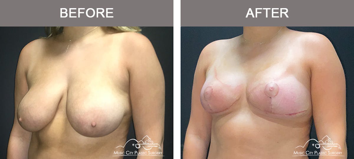 Breast Lift Before & After Gallery - Patient 336282 - Image 4