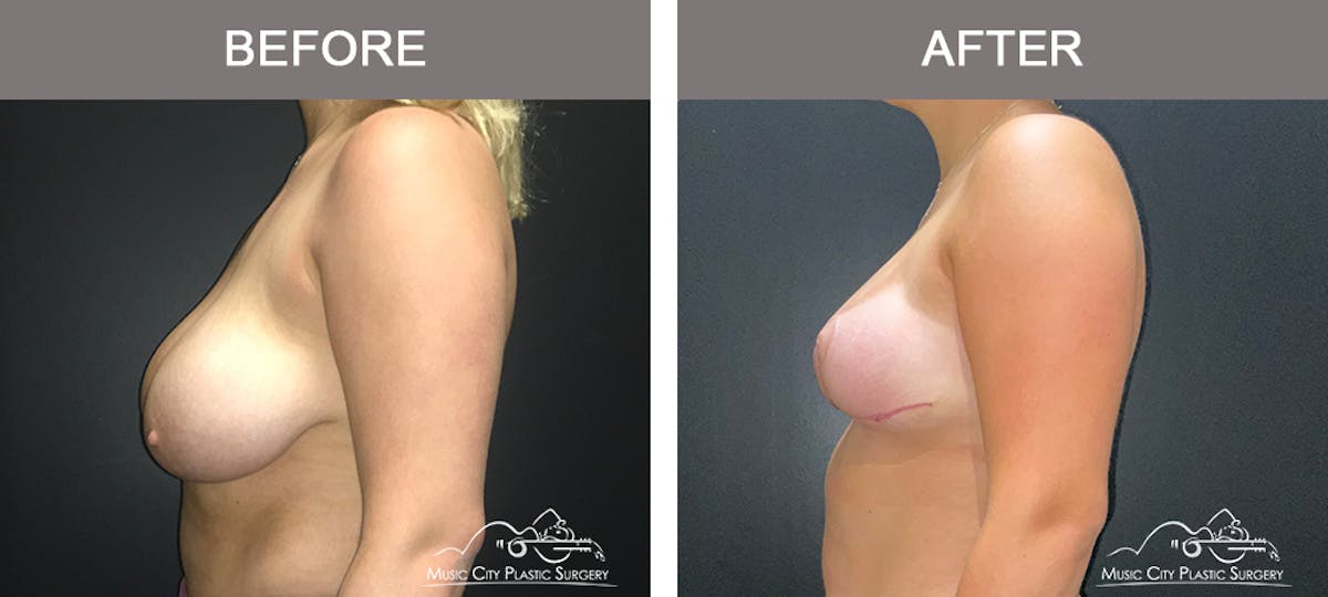 Breast Lift Before & After Gallery - Patient 336282 - Image 5