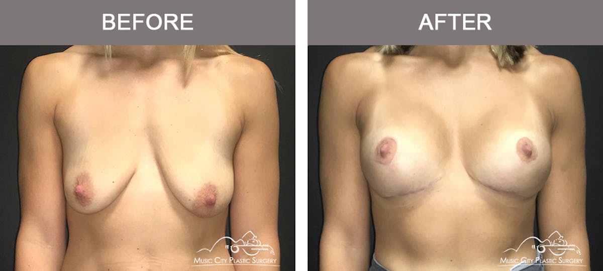 Breast Lift Before & After Gallery - Patient 183901 - Image 1