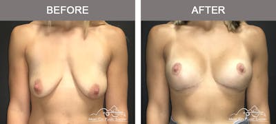Breast Augmentation Before & After Gallery - Patient 293333 - Image 1