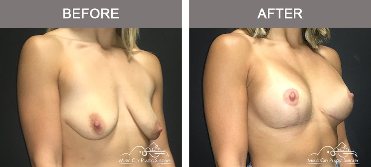 Breast Lift Before & After Gallery - Patient 183901 - Image 2