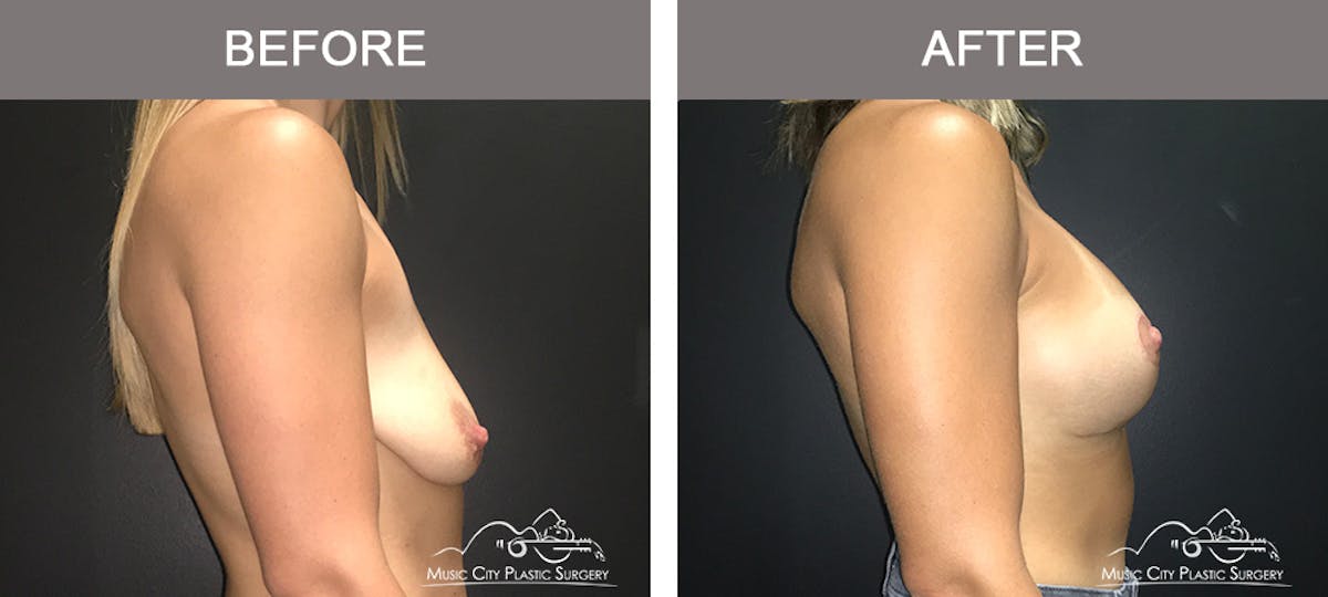 Breast Augmentation Before & After Gallery - Patient 293333 - Image 3