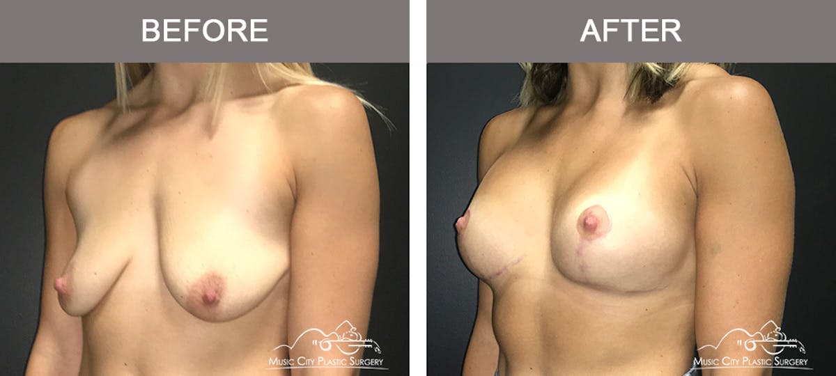Breast Lift Before & After Gallery - Patient 183901 - Image 4