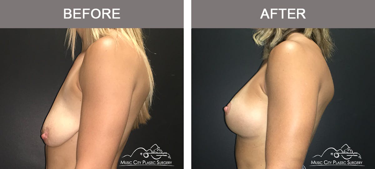 Breast Lift Before & After Gallery - Patient 183901 - Image 5