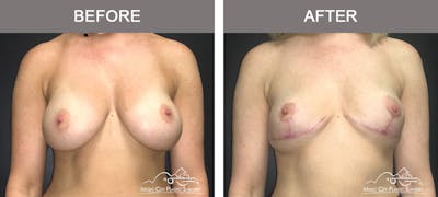 Mastopexy with Capsulectomy Before & After Gallery - Patient 111648 - Image 1