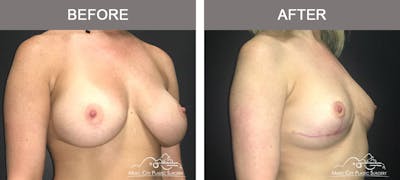 Mastopexy with Capsulectomy Before & After Gallery - Patient 111648 - Image 2