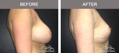 Mastopexy with Capsulectomy Before & After Gallery - Patient 111648 - Image 3
