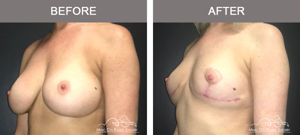 Mastopexy with Capsulectomy Before & After Gallery - Patient 111648 - Image 4