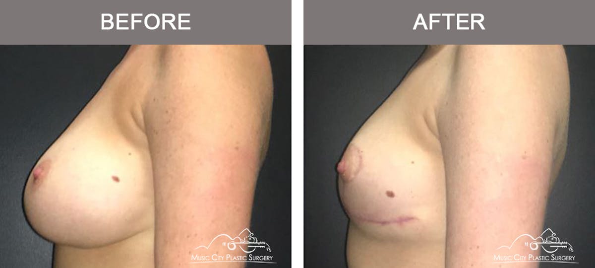 Mastopexy with Capsulectomy Before & After Gallery - Patient 111648 - Image 5