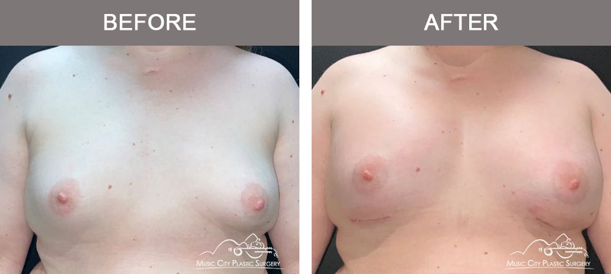 Breast Augmentation Before & After Gallery - Patient 228049 - Image 1