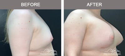 Breast Augmentation Before & After Gallery - Patient 228049 - Image 2