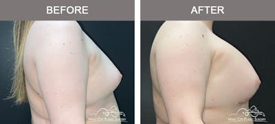 Breast Augmentation Before & After Gallery - Patient 228049 - Image 3