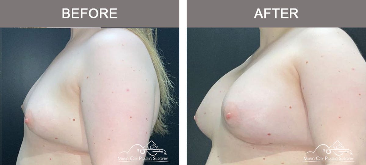 Breast Augmentation Before & After Gallery - Patient 228049 - Image 4
