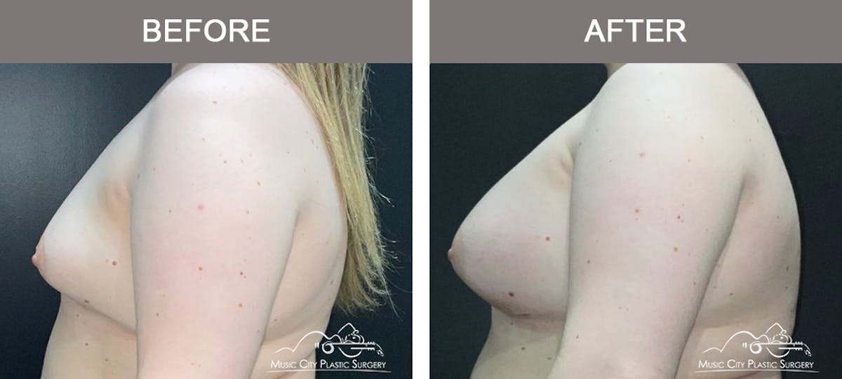 Breast Augmentation Before & After Gallery - Patient 228049 - Image 5