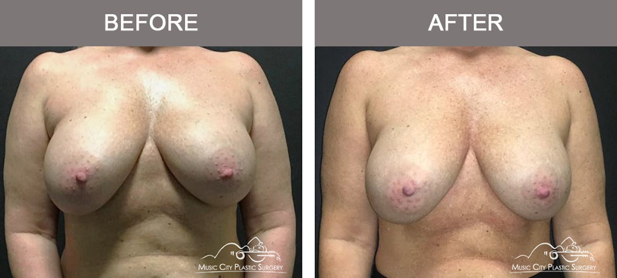 Breast Augmentation Before & After Gallery - Patient 354481 - Image 1