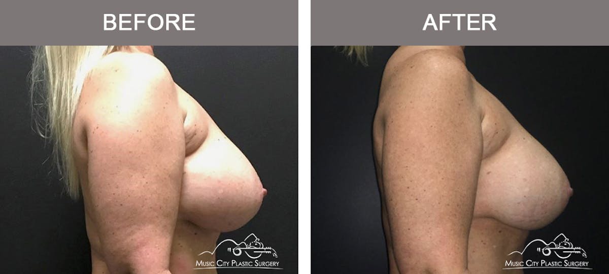 Breast Augmentation Before & After Gallery - Patient 354481 - Image 3