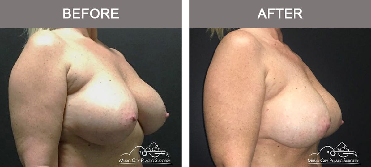 Breast Augmentation Before & After Gallery - Patient 354481 - Image 2