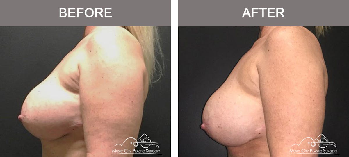 Breast Augmentation Before & After Gallery - Patient 354481 - Image 5