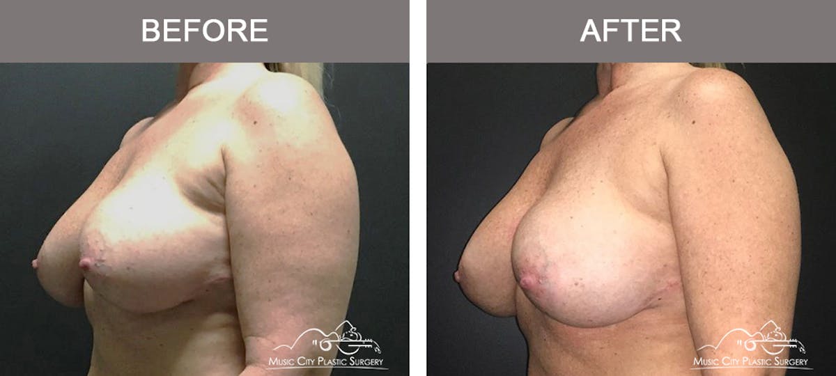 Breast Augmentation Before & After Gallery - Patient 354481 - Image 4