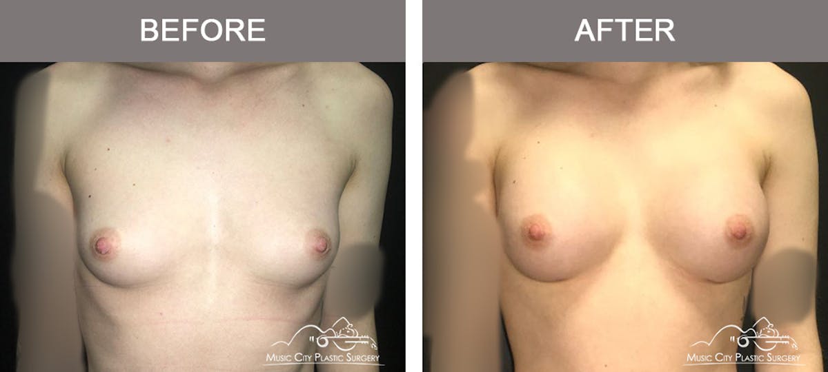 Breast Augmentation Before & After Gallery - Patient 156664 - Image 1