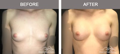 Breast Augmentation Before & After Gallery - Patient 156664 - Image 1