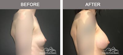 Breast Augmentation Before & After Gallery - Patient 156664 - Image 3