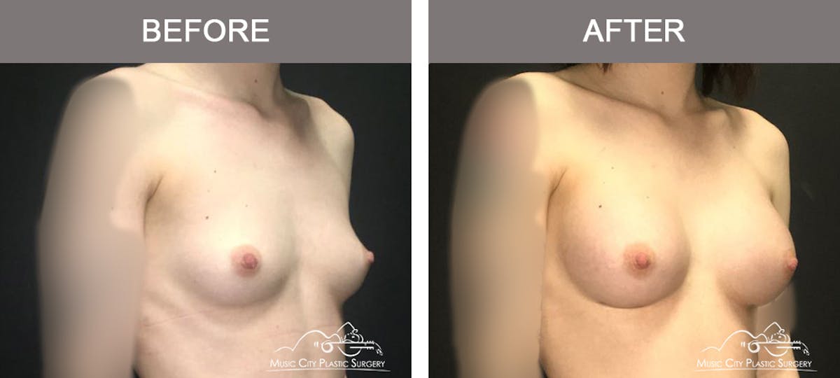 Breast Augmentation Before & After Gallery - Patient 156664 - Image 2