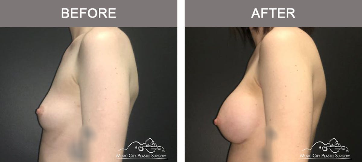 Breast Augmentation Before & After Gallery - Patient 156664 - Image 5