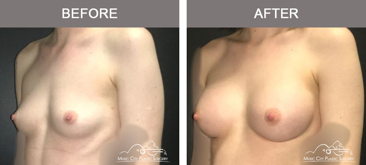 Breast Augmentation Before & After Gallery - Patient 156664 - Image 4