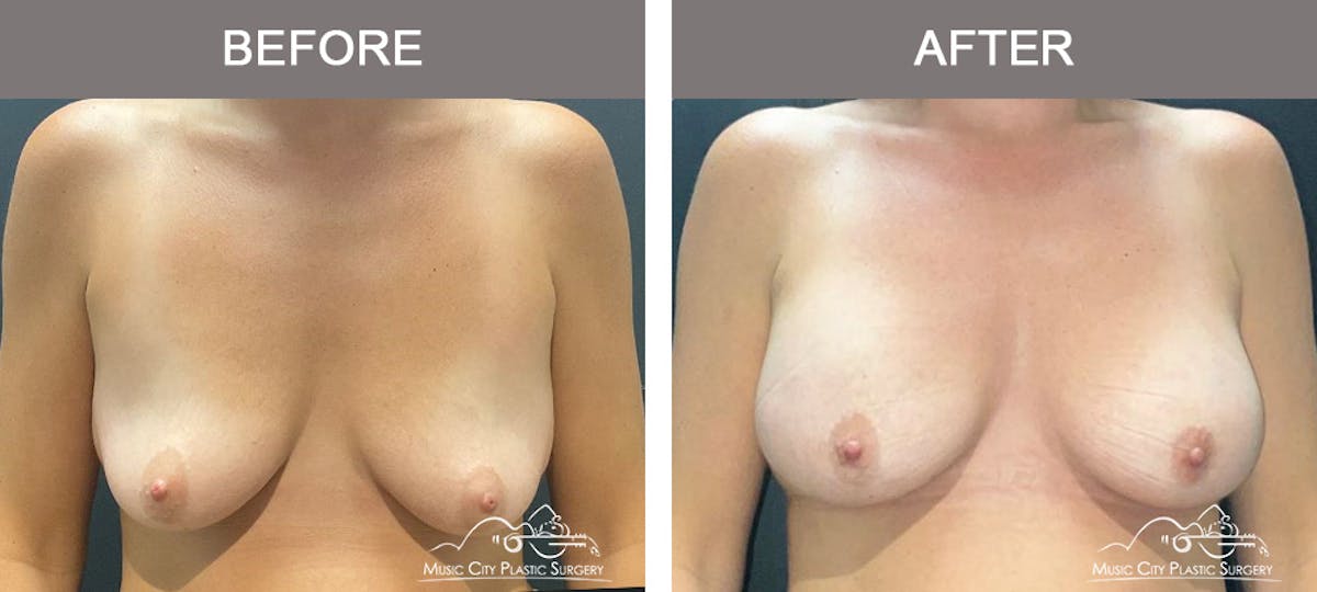Breast Augmentation Before & After Gallery - Patient 357344 - Image 1