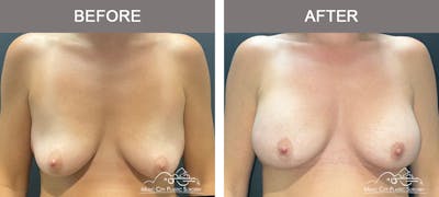 Breast Augmentation Before & After Gallery - Patient 357344 - Image 1