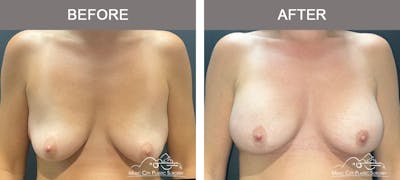Breast Augmentation Before & After Gallery - Patient 357344 - Image 1