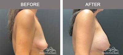 Breast Augmentation Before & After Gallery - Patient 357344 - Image 3