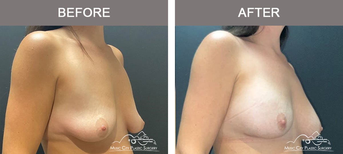 Breast Augmentation Before & After Gallery - Patient 357344 - Image 2
