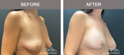 Breast Augmentation Before & After Gallery - Patient 357344 - Image 2