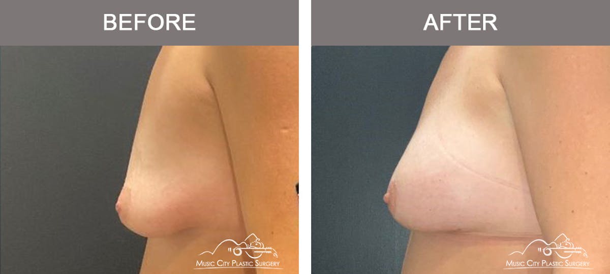 Breast Augmentation Before & After Gallery - Patient 357344 - Image 5