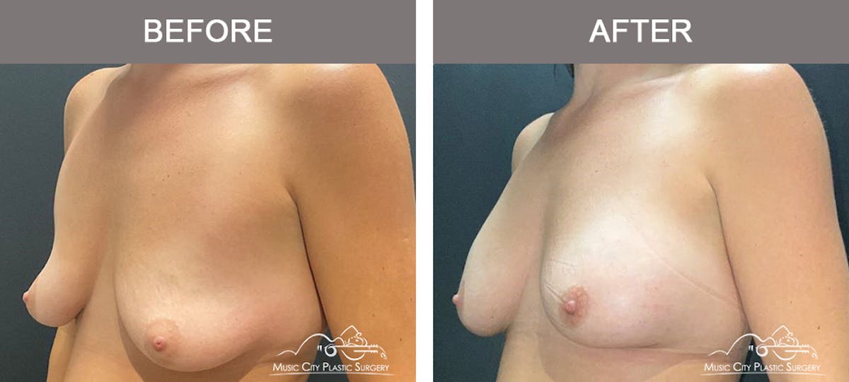 Breast Augmentation Before & After Gallery - Patient 357344 - Image 4