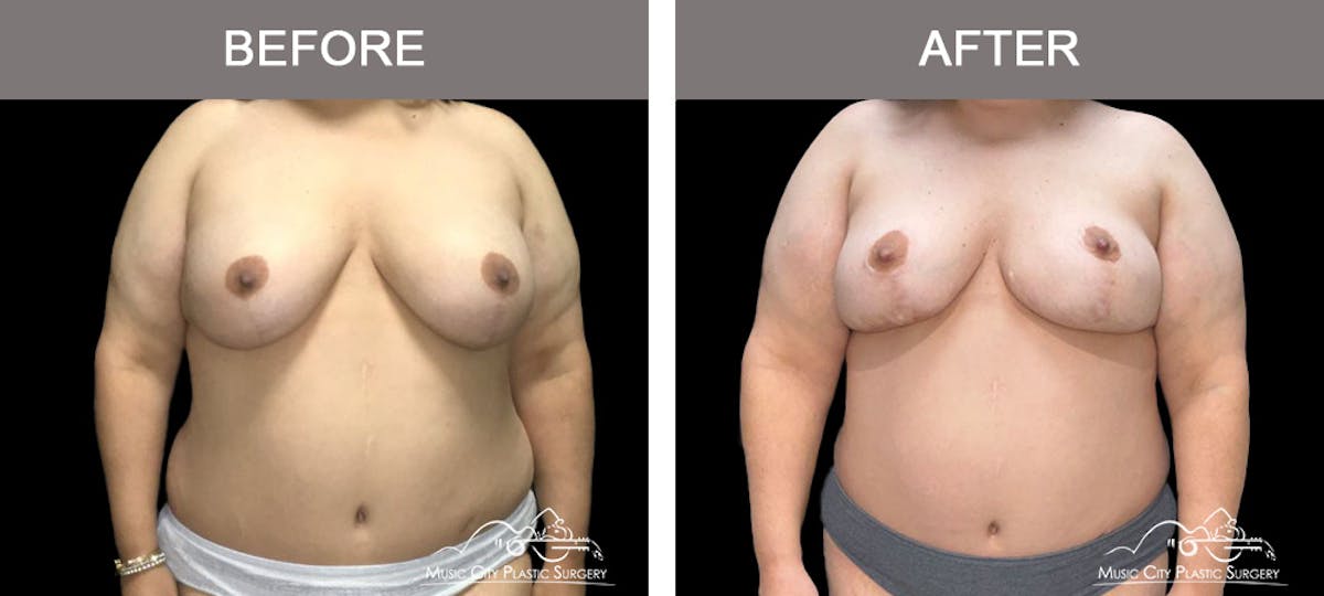 Capsulectomy Before & After Gallery - Patient 111834 - Image 1