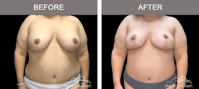 Breast Lift Before & After Gallery - Patient 418674 - Image 1