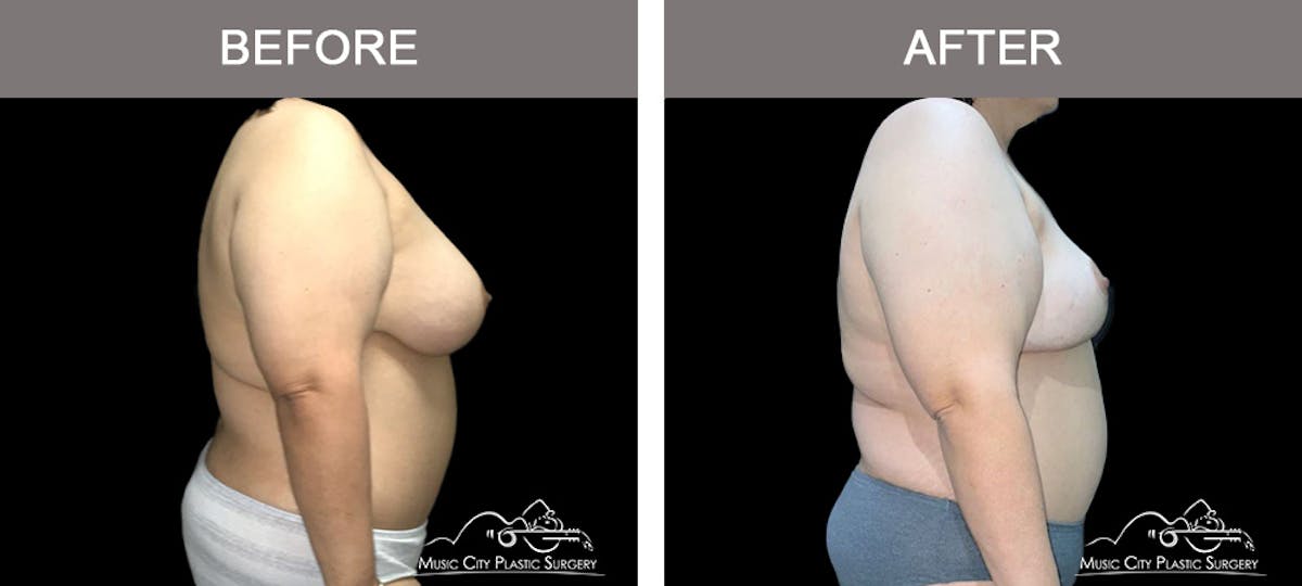 Capsulectomy Before & After Gallery - Patient 111834 - Image 3